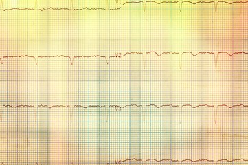 Heart analysis, electrocardiogram graph (ECG)
