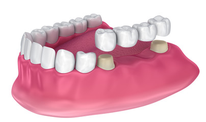 Tooth supported fixed bridge. Medically accurate 3D illustration