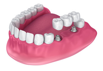 implant supported fixed bridge. Medically accurate 3D illustration