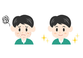 ニキビに悩む男性のイラスト: ビフォーアフター