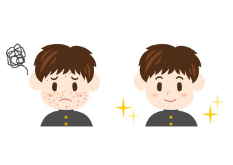 ニキビに悩む中学生男子のイラスト: ビフォーアフター