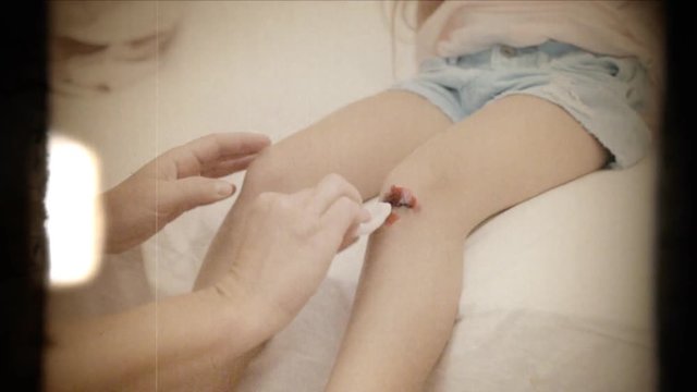 Fake 8mm amateur film: cleaning a bad bleeding wound under the knee of a little girl, with wet cotton.
