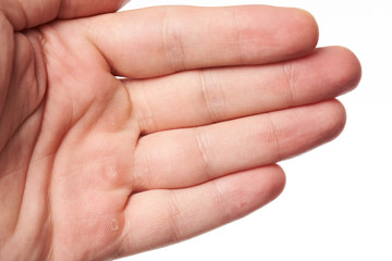 Hand palm with blister