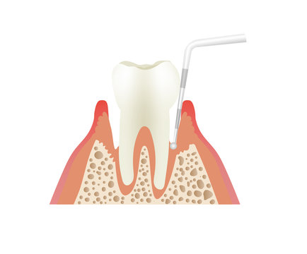 歯周ポケットのプローブ検査
