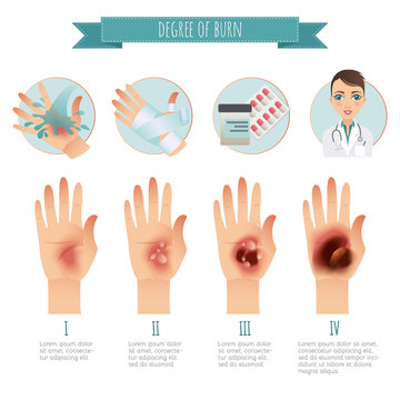 Burns Treatment. Degree of skin burns. Vector infographic. Flat Illustration for websites, brochures, magazines etc
