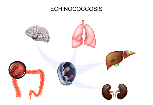 the causative agent Echinococcus