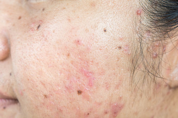 Fototapeta premium scar from acne on face