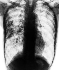 Pulmonary tuberculosis . Film x-ray of chest show patchy infiltrate at right lung due to TB infection