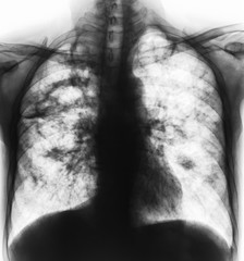 Pulmonary tuberculosis . Film x-ray of chest show cavity at right lung and interstitial infiltrate...