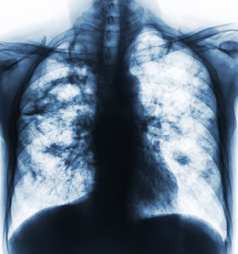 Pulmonary tuberculosis . Film x-ray of chest show cavity at right lung and interstitial infiltrate both lung due to TB infection
