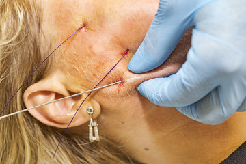 Dermatologist surgeon applies face lifting pdo procedure with filaments of polylactic acid applied in the face on a middle aged patient - Selective focus