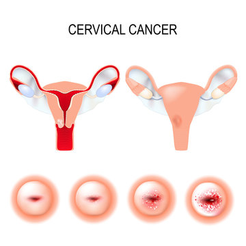 Cervical cancer staging