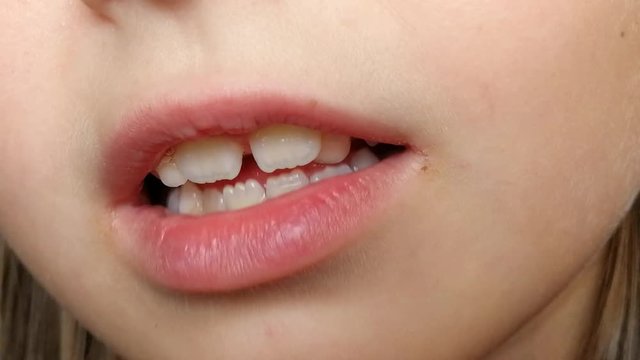 Young girl with one milk tooth