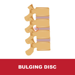 human disc degeneration. bulging disc vector illustration