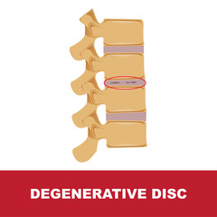 human disc degeneration. degenerative disc vector illustration