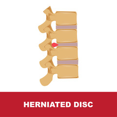 human disc degeneration. herniated disc vector illustration