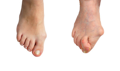 Medetcin, valgus bunion, Initial stage and advanced stage of the disease , leg with deformity...