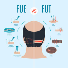 FUE vs FUT. Follicular unit extraction versus follicular unit transplantation. Types of hair transplant procedures and their stages. Male alopecia treatment. Medical infographics. Vector illustration.