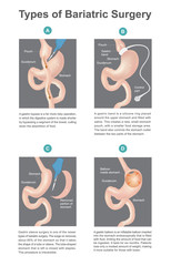 Obraz premium Types of bariatric surgery, it’s process for the digestive system in stomach, .A new types of bariatric surgery result in patients lose only of weight. Part of human body. Infographic vector..