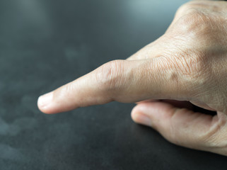 Hand of patient Rheumatoid Arthritis