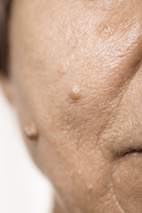Fototapeta premium Elderly pensioner female, dermal fibroma closeup.