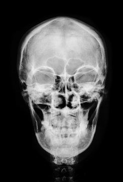 front face skull x-ray.