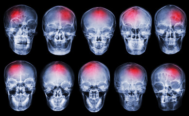 Stroke . Cerebrovascular accident . Set of film x-ray skull
