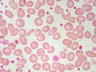 Red blood cells and platelet in blood smear
