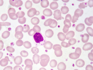 Lymphocyte cell (white blood cell) in blood smear, analyze by microscope