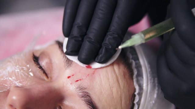 Closeup view of doctor's hands in black gloves making multiple injections in woman's face skin during mesotherapy. Biorevitalization and face lifting, non-surgical cosmetic medicine treatment