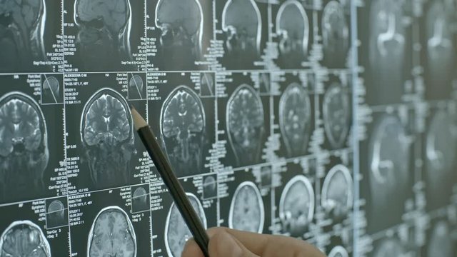 Rack focus shot of unrecognizable doctor holding pencil and pointing at sections of MRI scan of brain