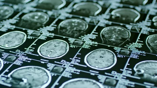 Close up of CT scan of brain with projection of coronal, axial and sagittal planes