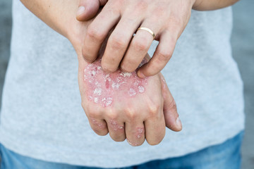 Man scratch oneself, dry flaky skin on hand with psoriasis vulgaris, eczema and other skin conditions like fungus, plaque, rash and patches. Autoimmune genetic disease.