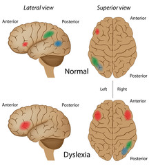 Dyslexia brain activity - obrazy, fototapety, plakaty
