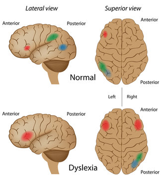 Dyslexia Brain Activity