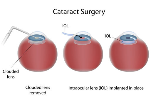 Cataract surgery 