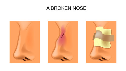 a broken nose