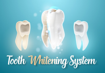 Illustration of 3D Realistic Vector Teeth Cleaning Process. Vector Tooth Cleaning Treatment. Healthcare Stomatology Procedure