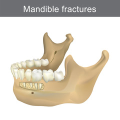 Mandible fractures is the largest, strongest and lowest bone in the face. Part of human body. Infographic Anatomy.