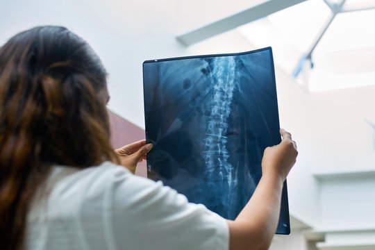 Xray technician holding image of patient with scoliosis