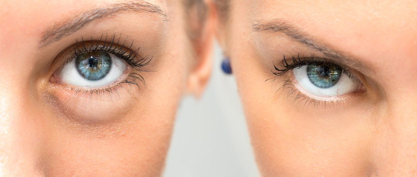Eye with and without swelling before and after cosmetic treatment