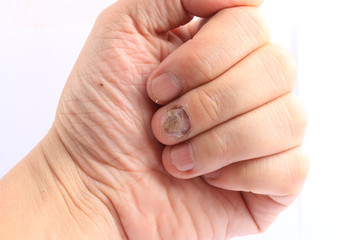 Fungus Infection on Nails Hand, Finger with onychomycosis, Fungal infection on nails handisolated...