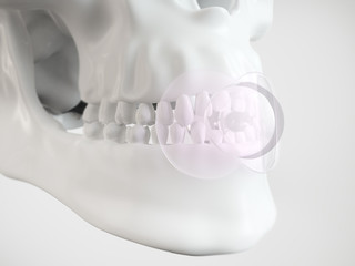 Open bite by pacifiers - 3D rendering © crevis