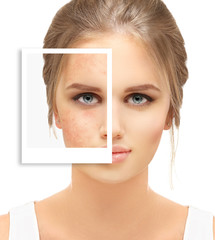 Post-Acne Marks /Treating Acne Scars