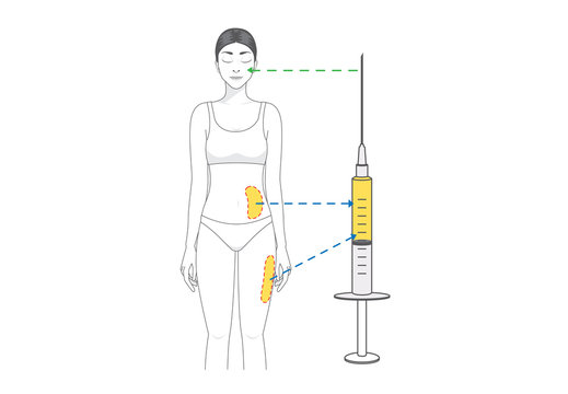 Beauty Woman Make Fat Transfer From Buttocks To Facial For Wrinkles Reduction. Illustration About Cosmetic Surgery.