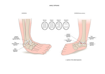Two common types of ankle sprain (inversion and eversion) - obrazy, fototapety, plakaty
