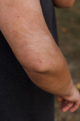 Naklejka premium psoriasis on an elbow showing redness and dry patches.Eczema and other dry skin conditions
