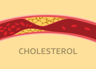 a cholesterol human body vein with blood cell stream - obrazy, fototapety, plakaty