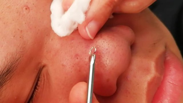 Torture and pain suffer from squeezing pimple blackheads from the face of a teenager with a blackhead popper

