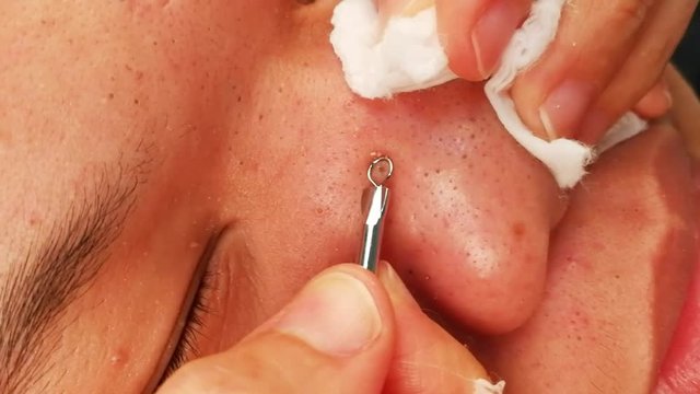 Torture and pain suffer from squeezing pimple blackheads from the face of a teenager with a blackhead popper

